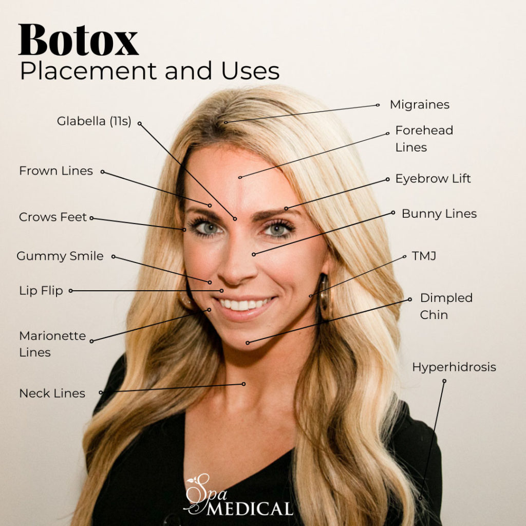 Does Botox Fix Smile Lines